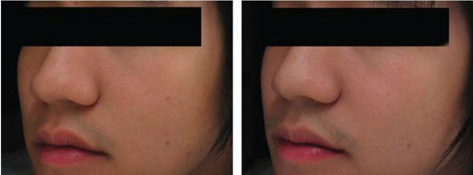 Glutathione giúp sáng da sau 4 tuần theo nghiên cứu của Arjinpathana & Asawanonda, 2012